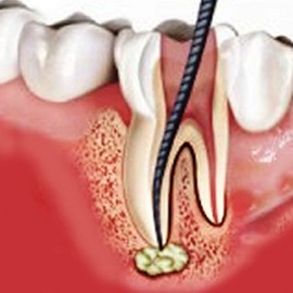 endodonzia